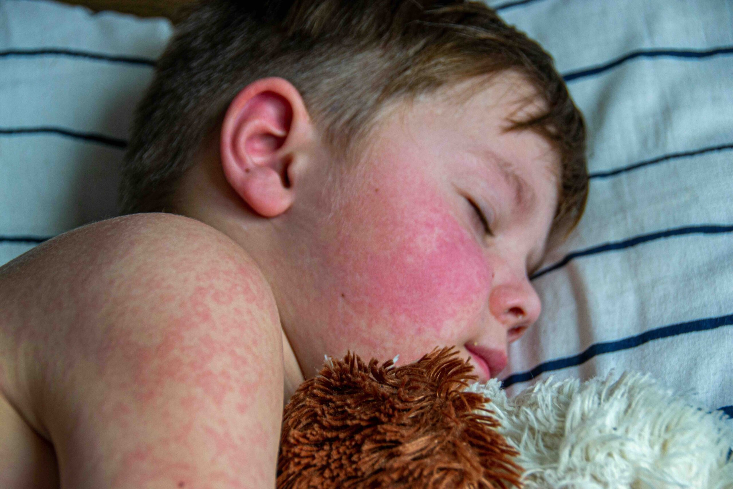 Kid sick with Measles
